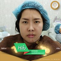 hifu review ydc 02