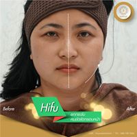 hifu review ydc 03