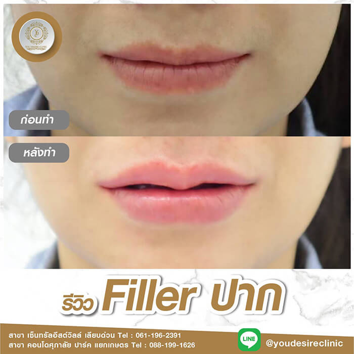 filler lips 01 (1)