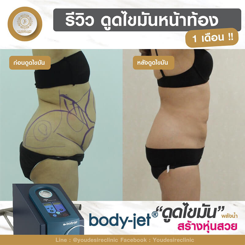 liposuction review 0001