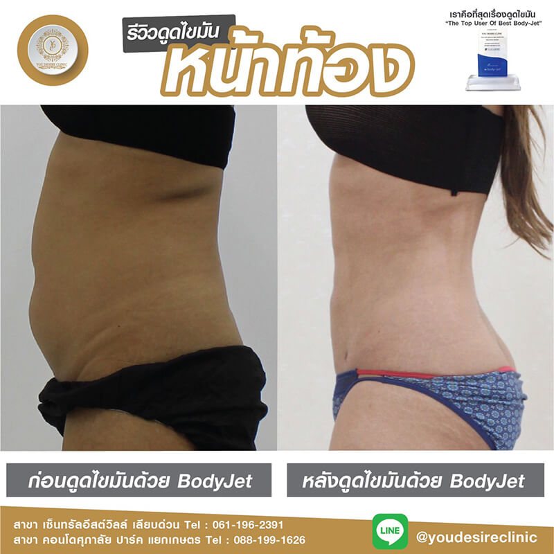 liposuction review 0002