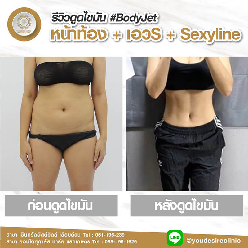 liposuction review 0003