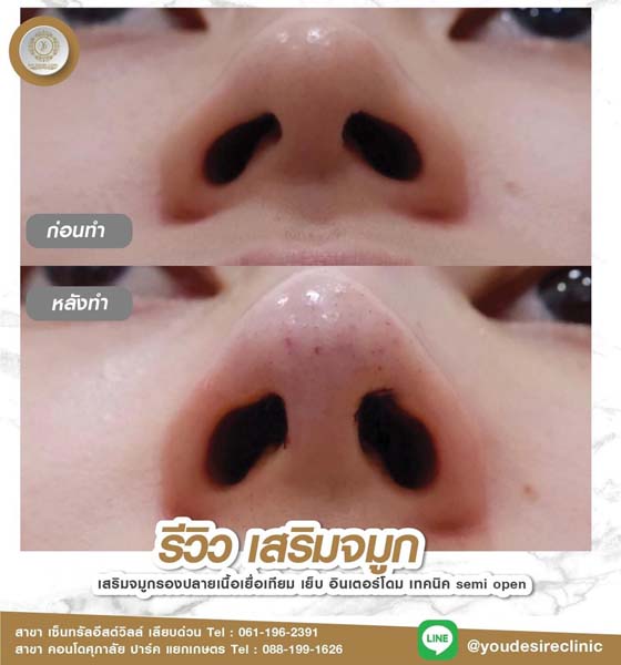 nose surgery review