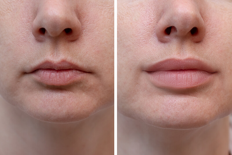 filler lips ydc clinic